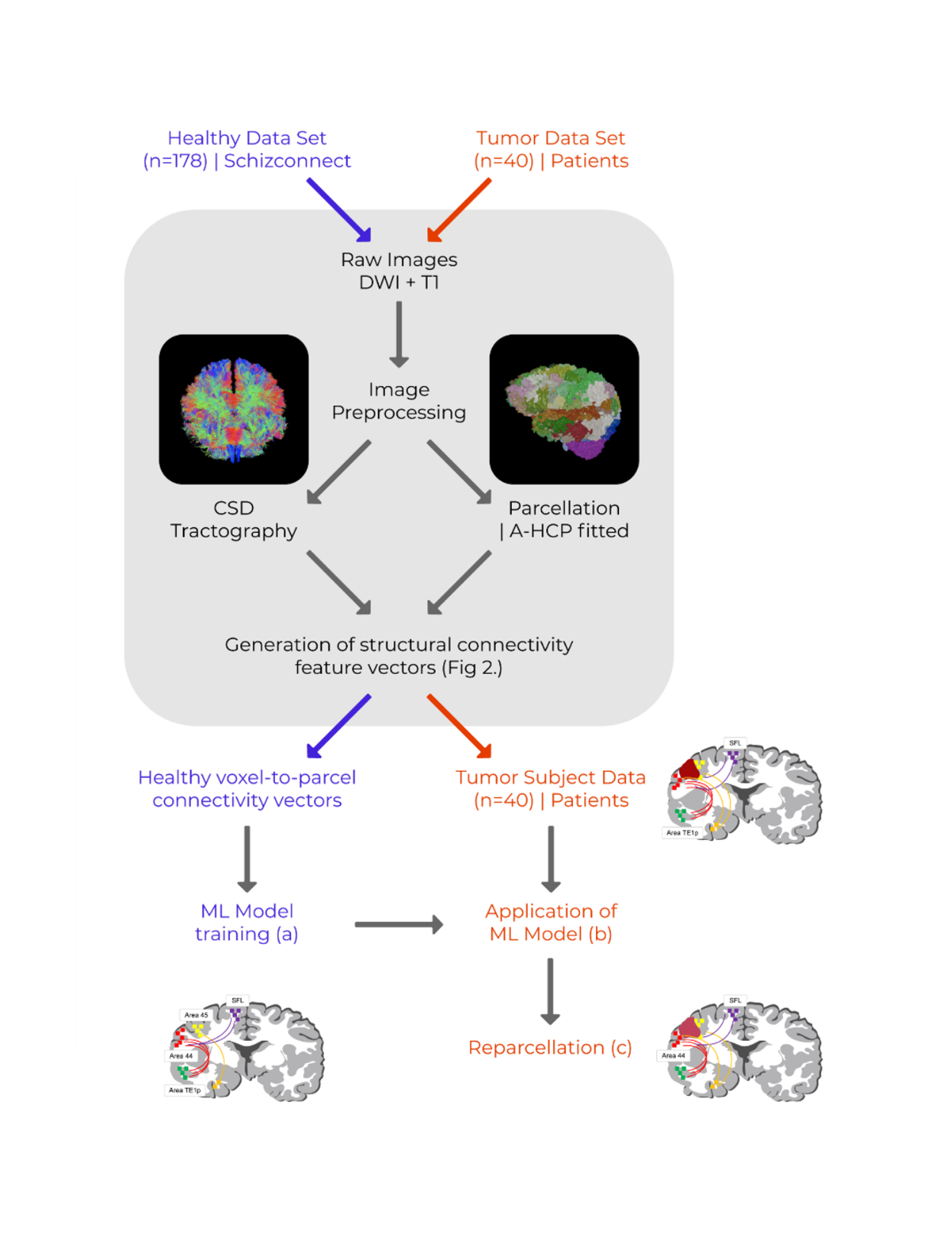 How Personalized Mapping Of Brain Networks Aids Neurosurgery